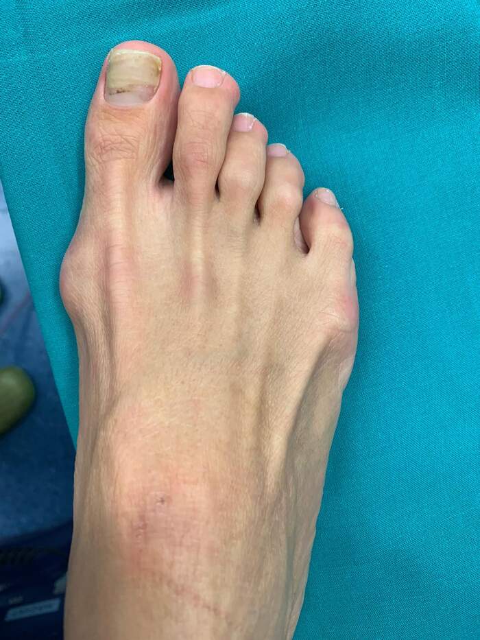 Hallux Valgus — corrección quirúrgica con excelente resultado