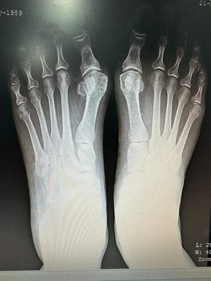 Hallux Valgus bilateral severo — corrección completa del antepié