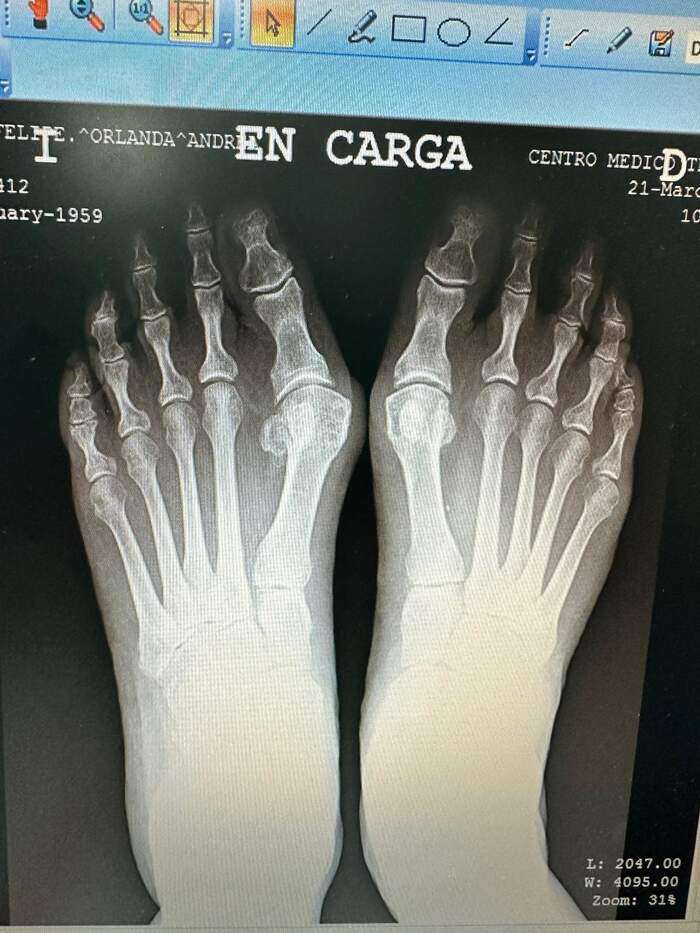 Hallux Valgus bilateral severo — corrección completa del antepié