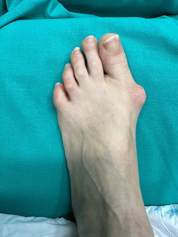 Hallux Valgus bilateral severo — corrección completa del antepié