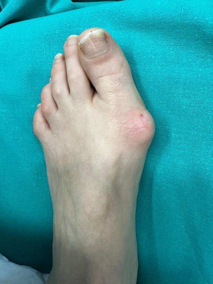 Hallux Valgus bilateral severo — corrección completa del antepié
