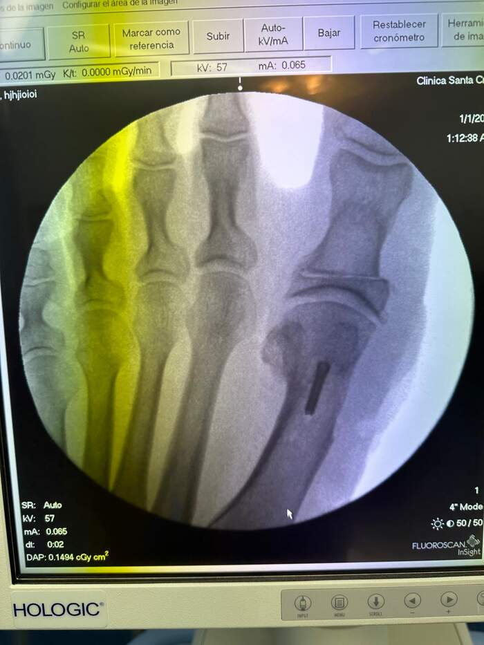 Hallux Valgus bilateral severo — corrección completa del antepié