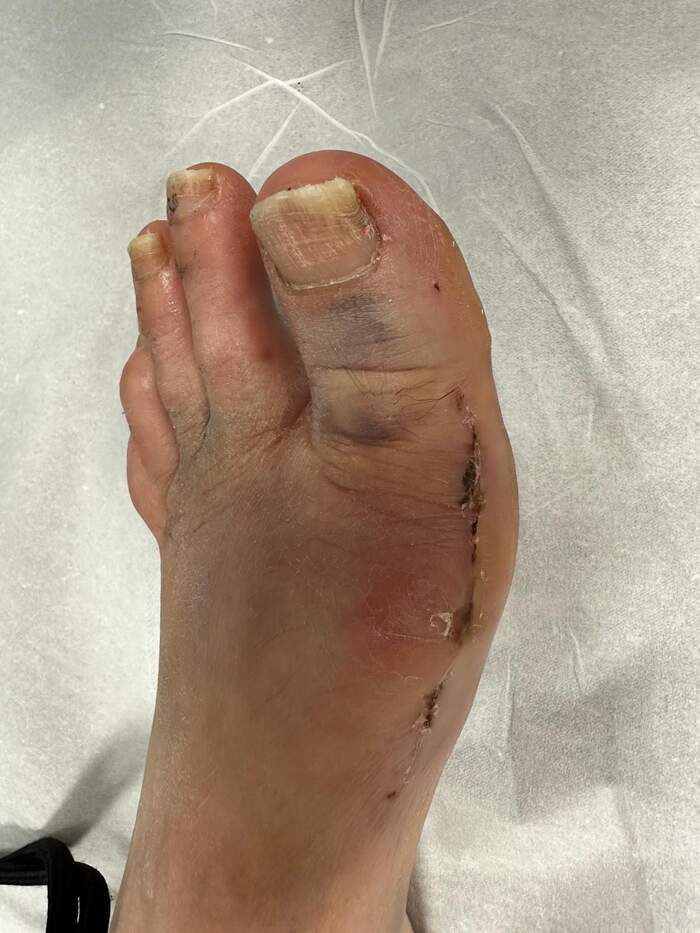 Hallux Valgus bilateral severo — corrección completa del antepié