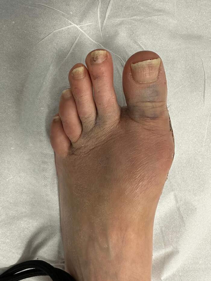 Hallux Valgus bilateral severo — corrección completa del antepié