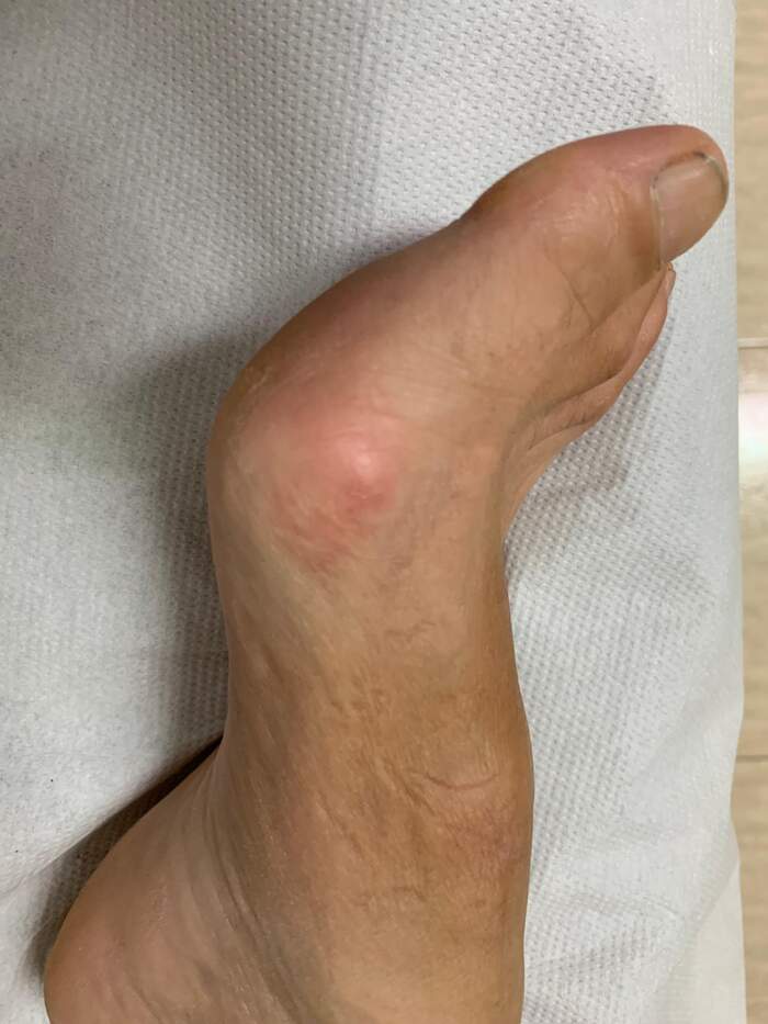 Hallux Valgus (juanete) — corrección por microcirugía