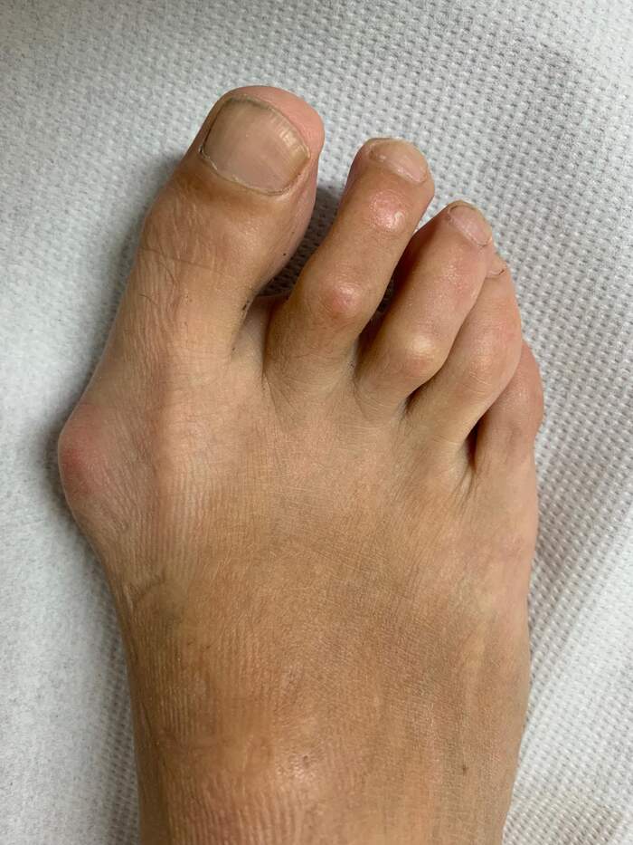Hallux Valgus (juanete) — corrección por microcirugía