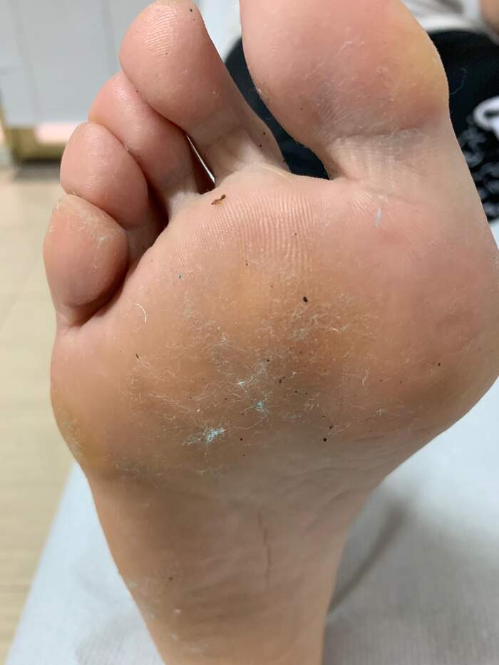 Hallux Valgus (juanete) — corrección por microcirugía