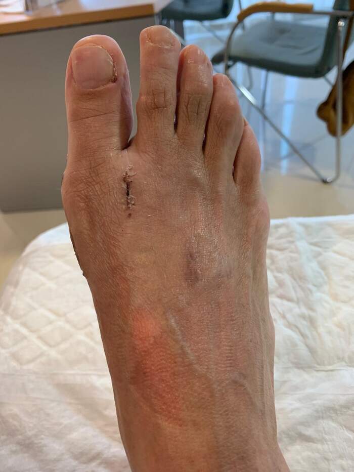Hallux Valgus (juanete) — corrección por microcirugía