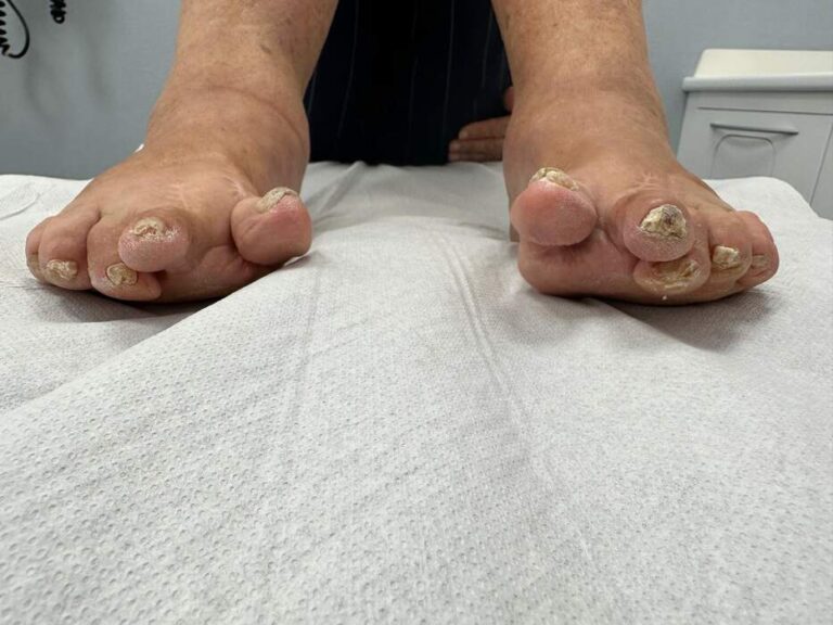 Hallux Valgus severo con deformidades múltiples — paciente que rechazaba operarse