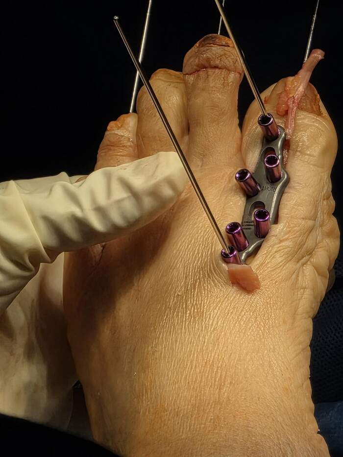 Hallux Valgus severo con deformidades múltiples — paciente que rechazaba operarse