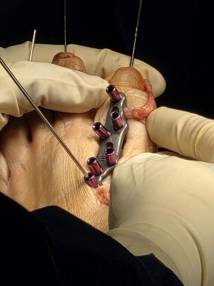Hallux Valgus severo con deformidades múltiples — paciente que rechazaba operarse