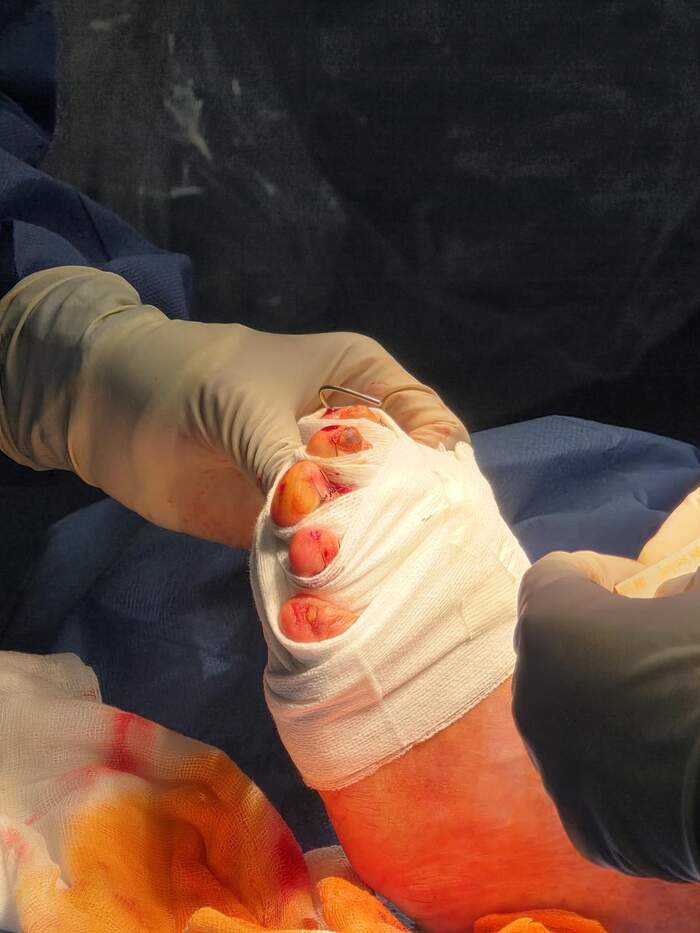 Hallux Valgus severo con deformidades múltiples — paciente que rechazaba operarse
