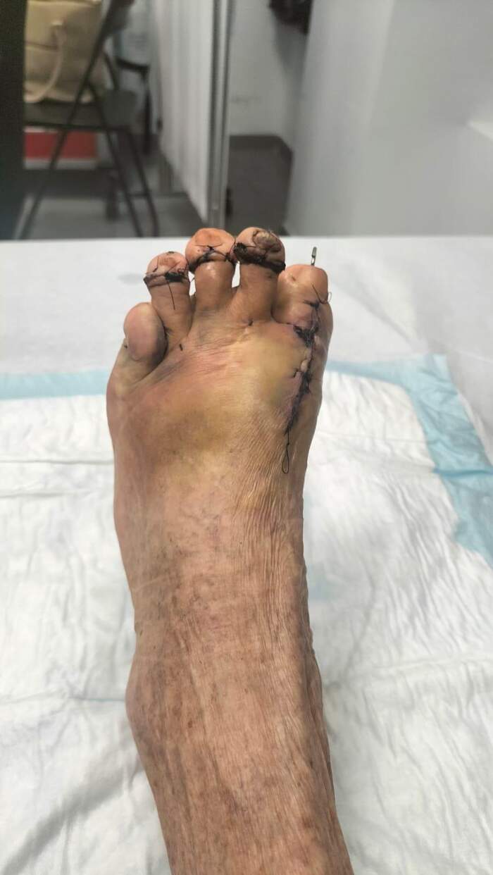 Hallux Valgus severo con deformidades múltiples — paciente que rechazaba operarse