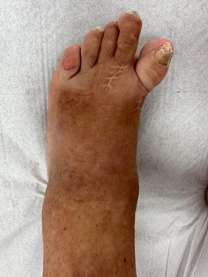 Hallux Valgus severo con deformidades múltiples — paciente que rechazaba operarse