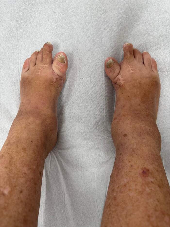 Hallux Valgus severo con deformidades múltiples — paciente que rechazaba operarse