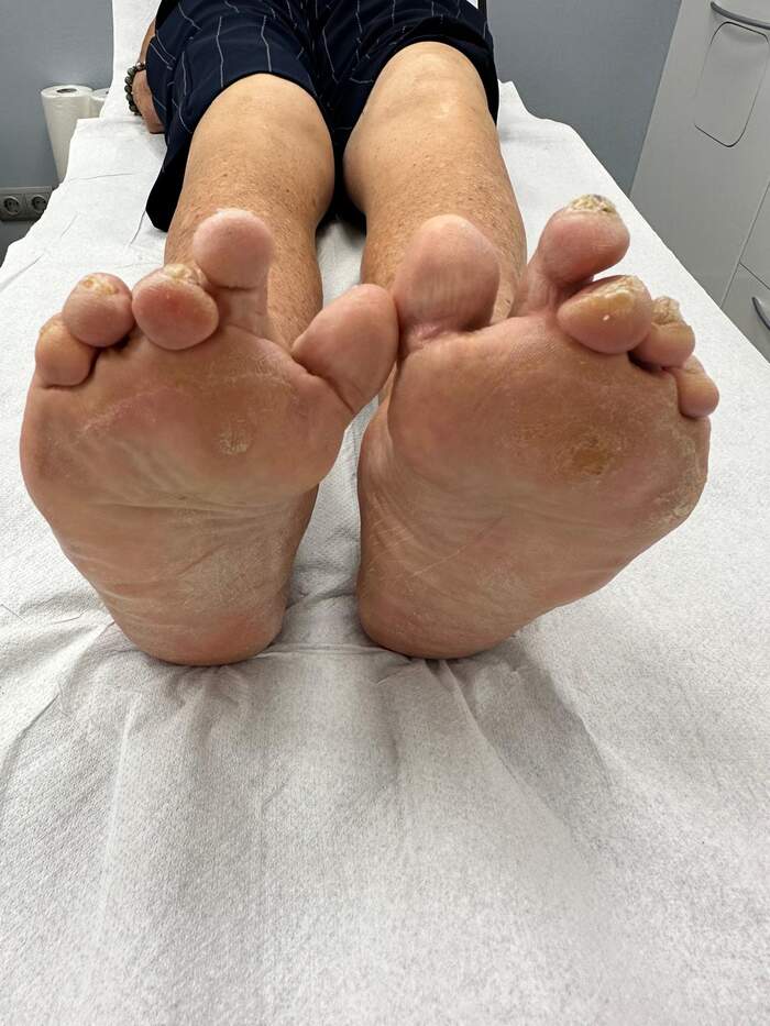 Hallux Valgus severo con deformidades múltiples — paciente que rechazaba operarse