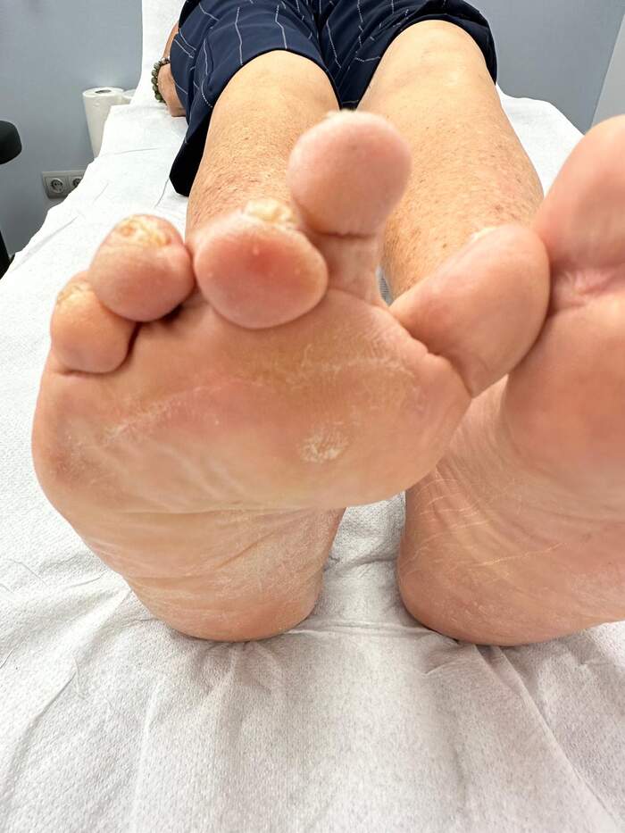Hallux Valgus severo con deformidades múltiples — paciente que rechazaba operarse