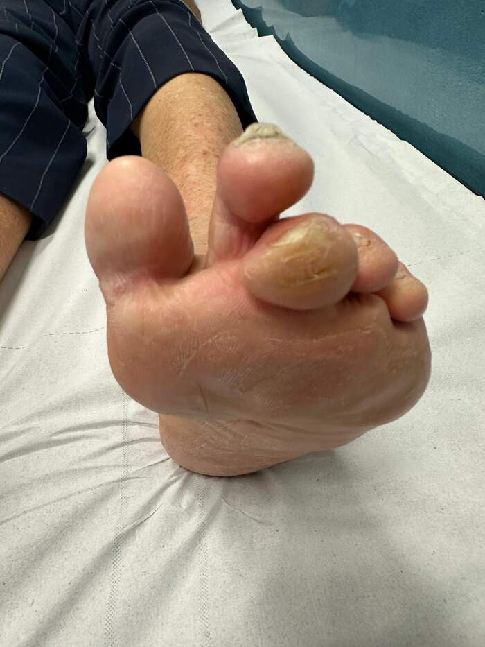 Hallux Valgus severo con deformidades múltiples — paciente que rechazaba operarse
