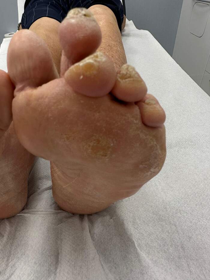 Hallux Valgus severo con deformidades múltiples — paciente que rechazaba operarse