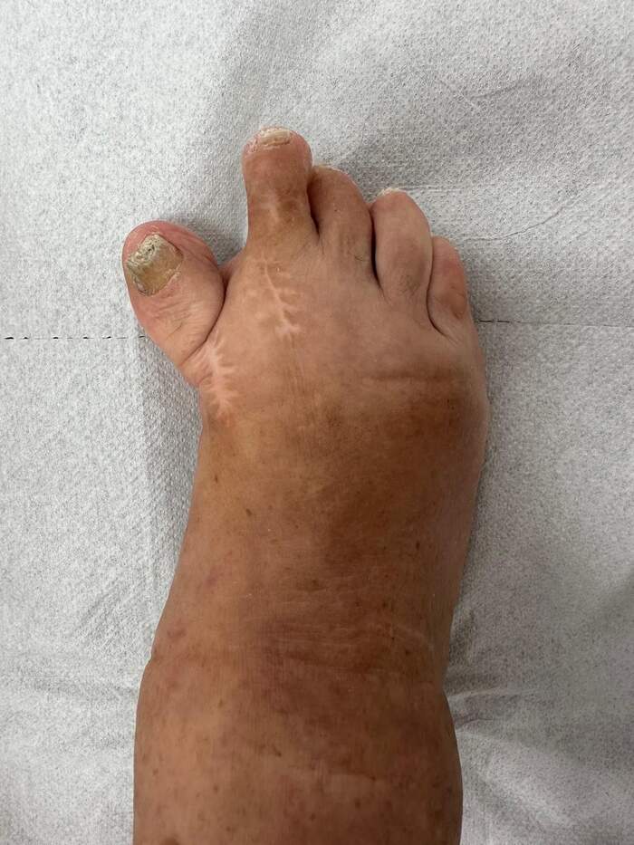 Hallux Valgus severo con deformidades múltiples — paciente que rechazaba operarse