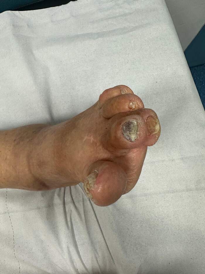 Hallux Valgus severo con deformidades múltiples — paciente que rechazaba operarse