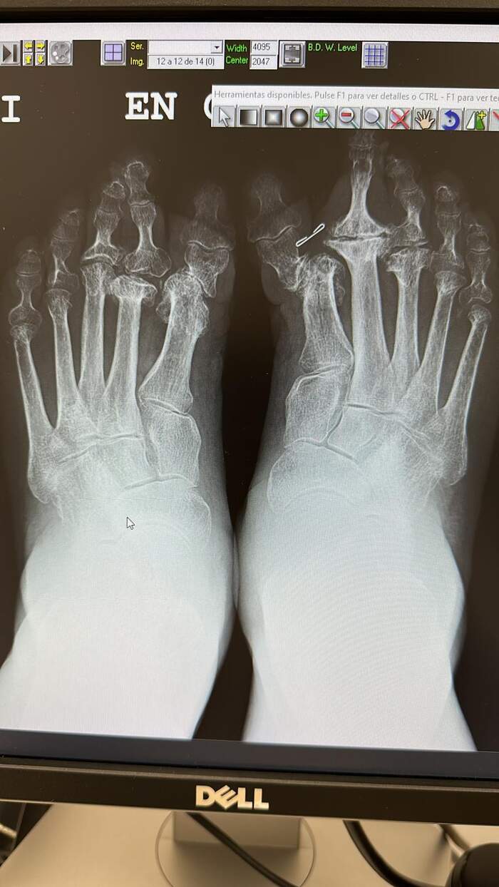Hallux Valgus severo con deformidades múltiples — paciente que rechazaba operarse