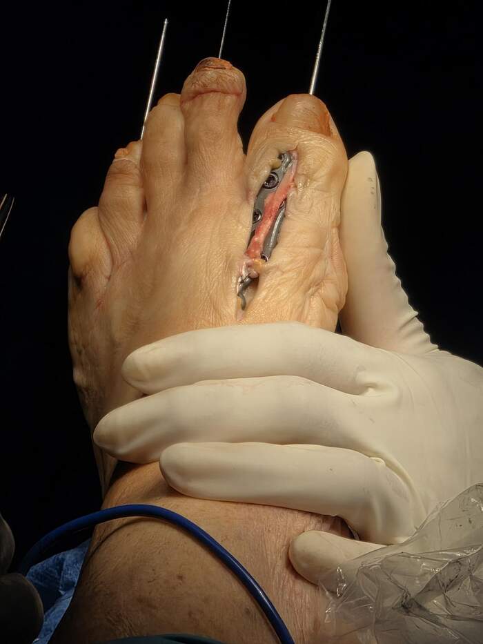 Hallux Valgus severo con deformidades múltiples — paciente que rechazaba operarse