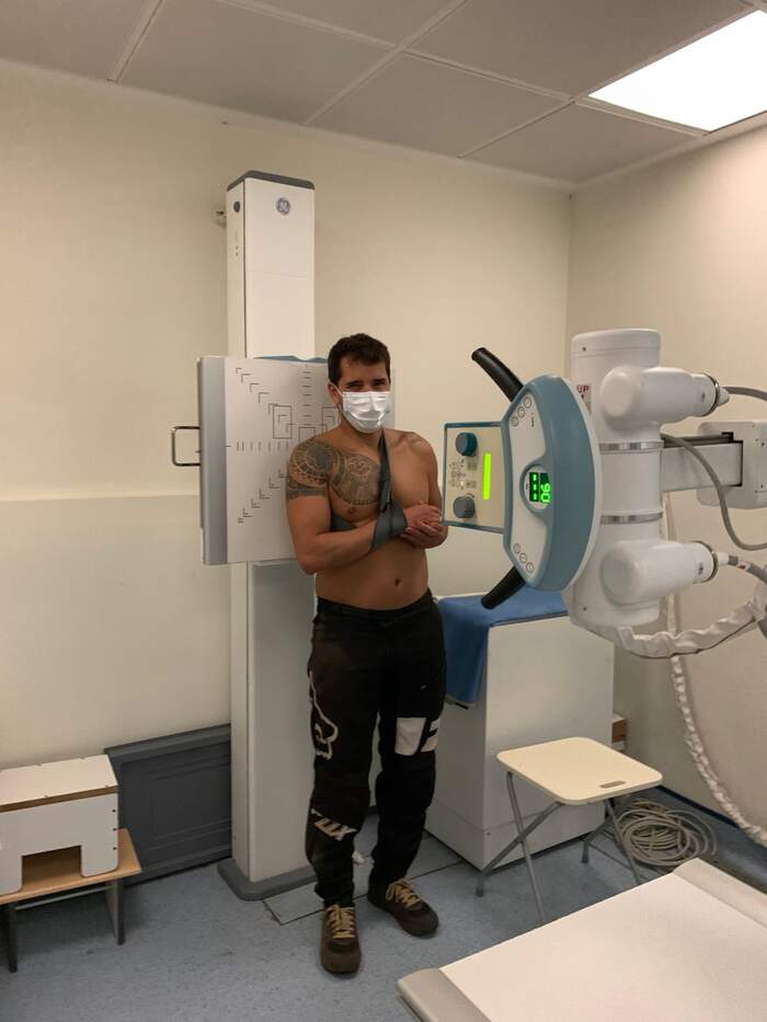 Luxación acromioclavicular en deportista de motocross