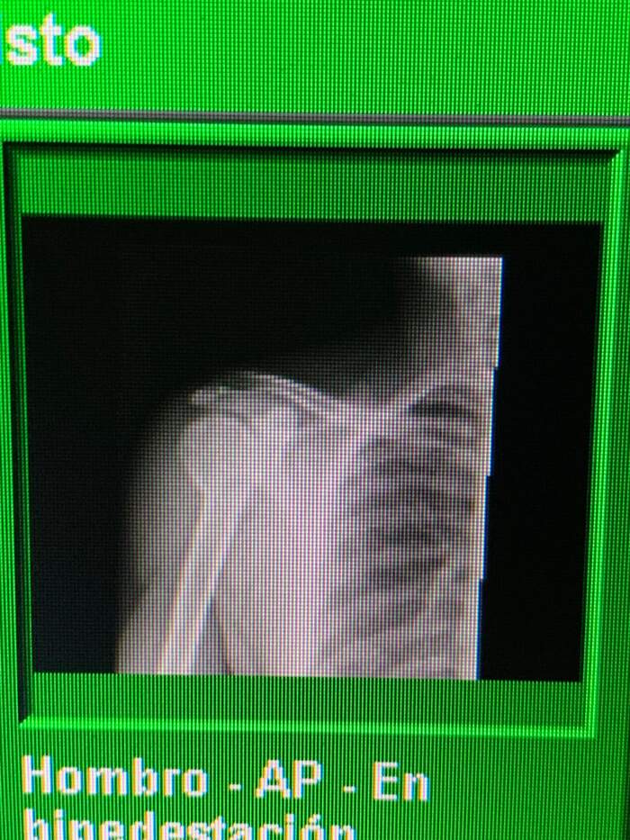 Luxación acromioclavicular en deportista de motocross
