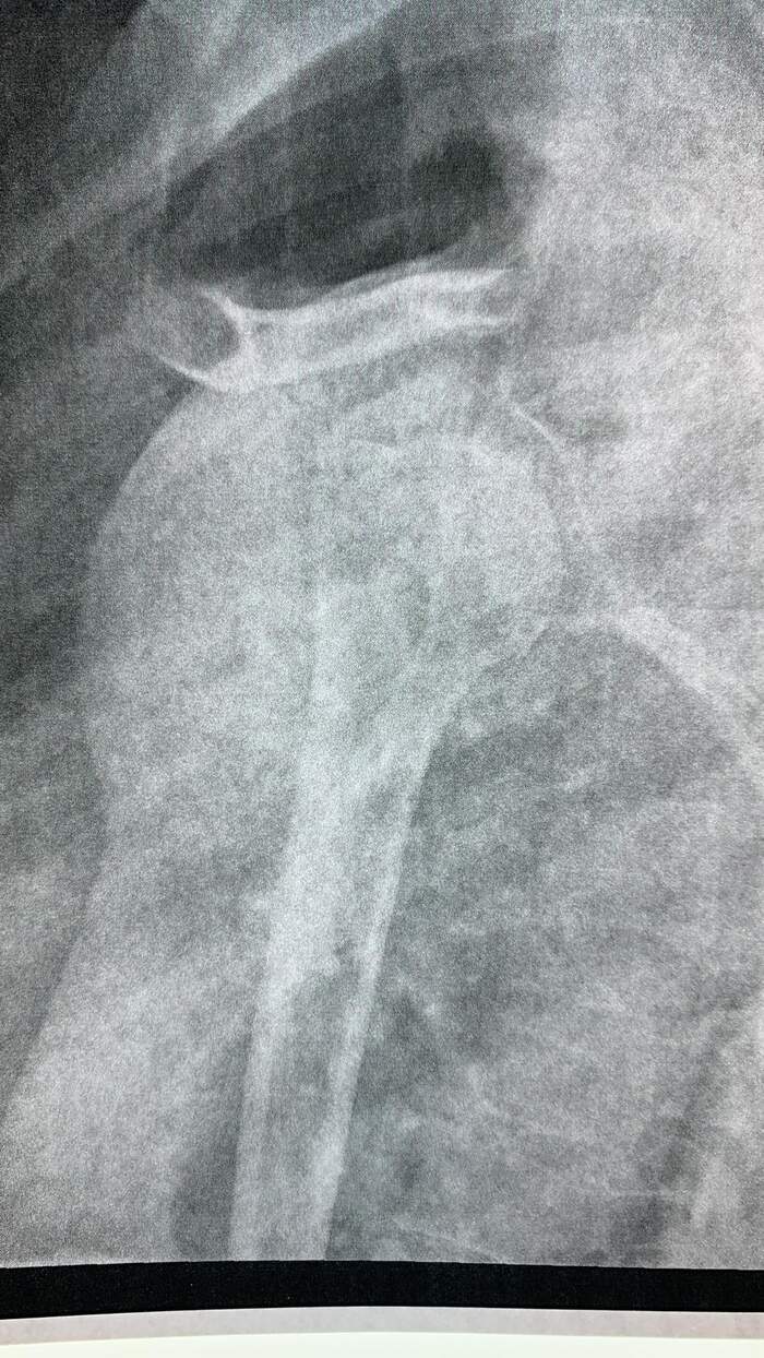 Luxación acromioclavicular en deportista de motocross