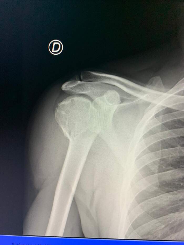 Luxación acromioclavicular en deportista de motocross