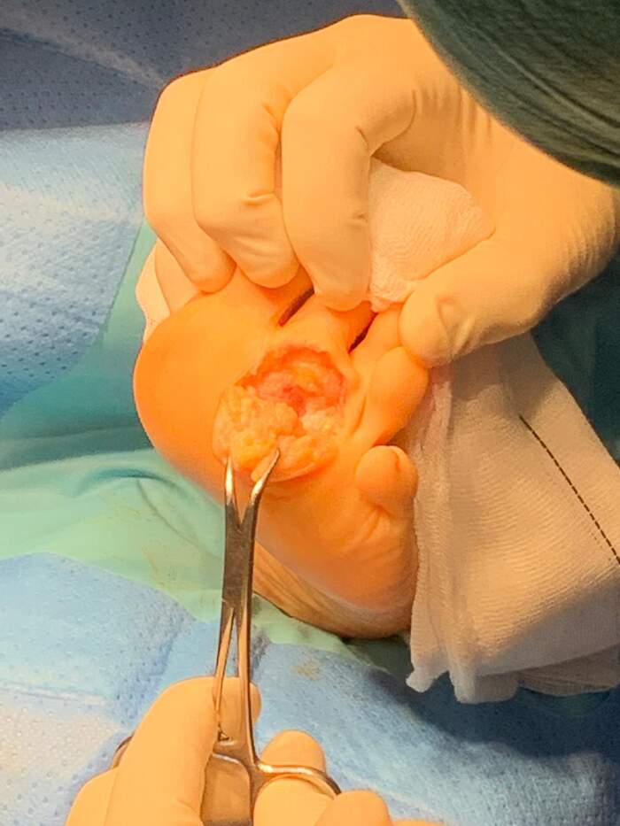 Neuroma de Morton — extirpación quirúrgica