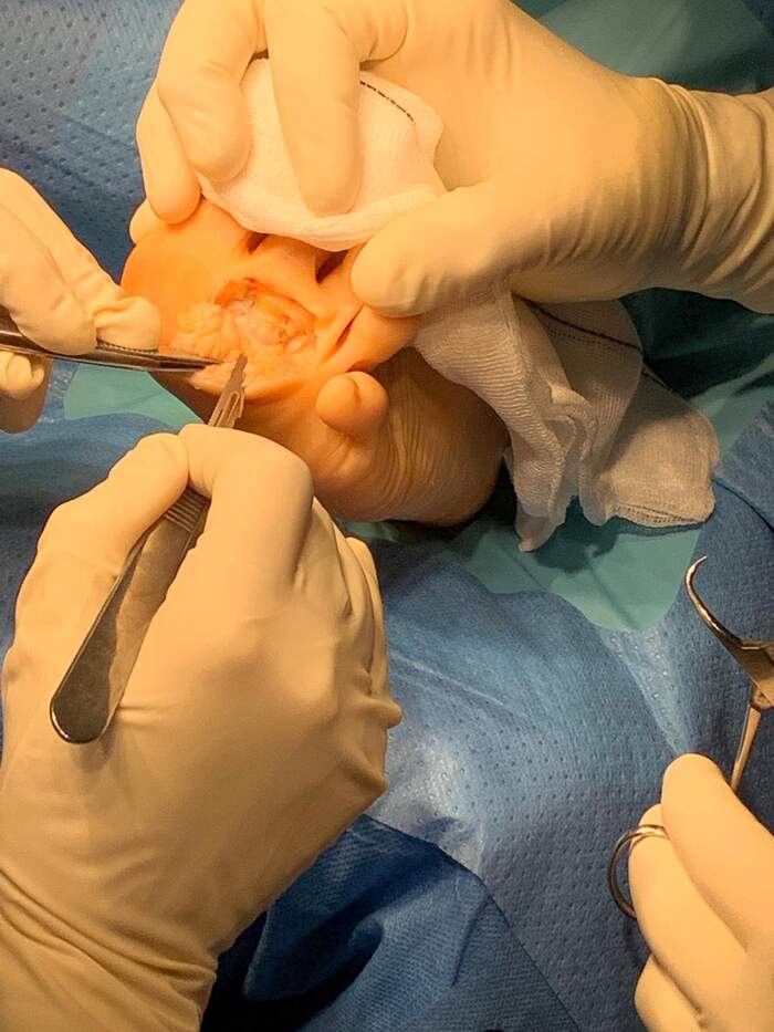 Neuroma de Morton — extirpación quirúrgica