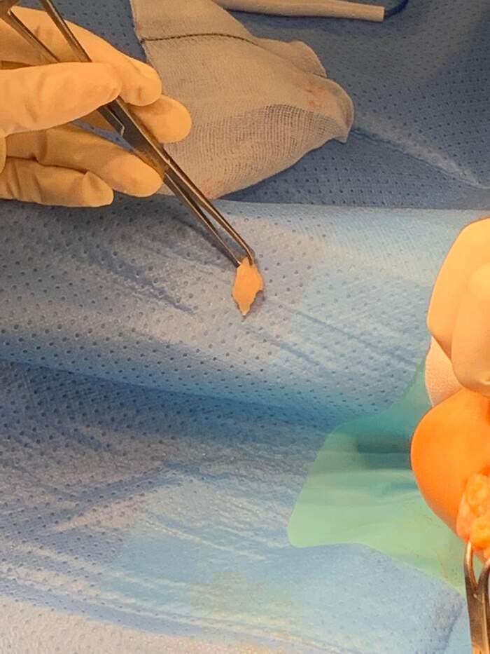 Neuroma de Morton — extirpación quirúrgica