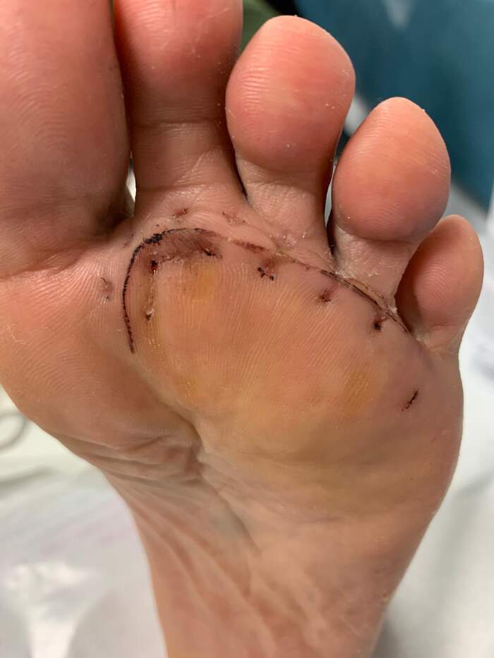 Neuroma de Morton — extirpación quirúrgica