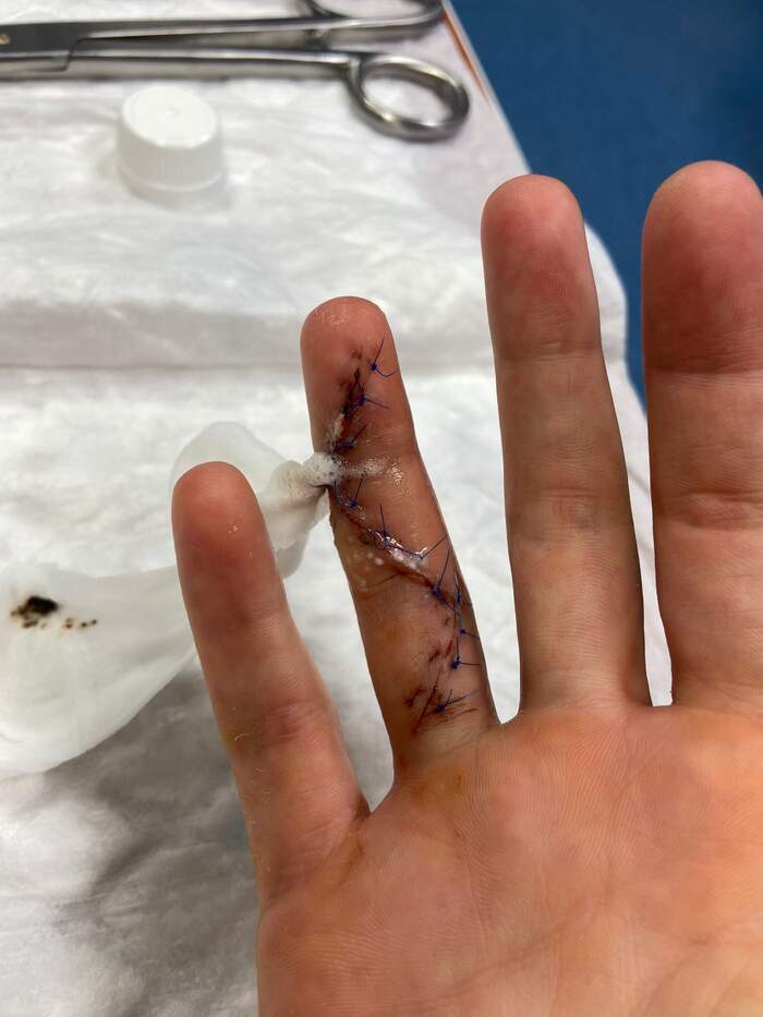 Rotura aguda del flexor profundo del dedo anular en jugadora de waterpolo