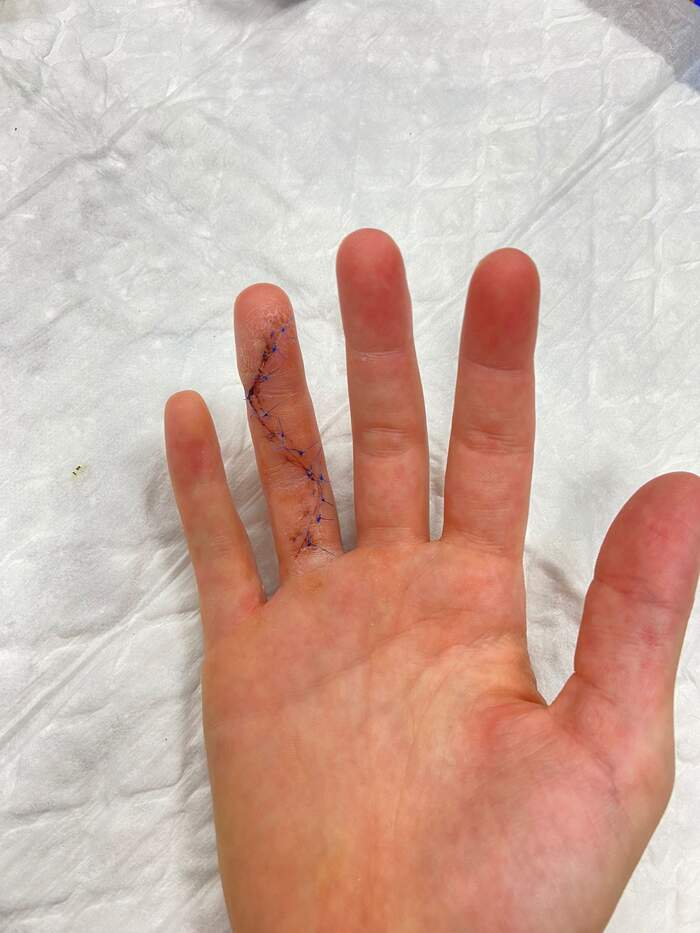Rotura aguda del flexor profundo del dedo anular en jugadora de waterpolo
