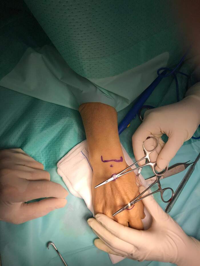 Sección parcial del tendón extensor del pulgar