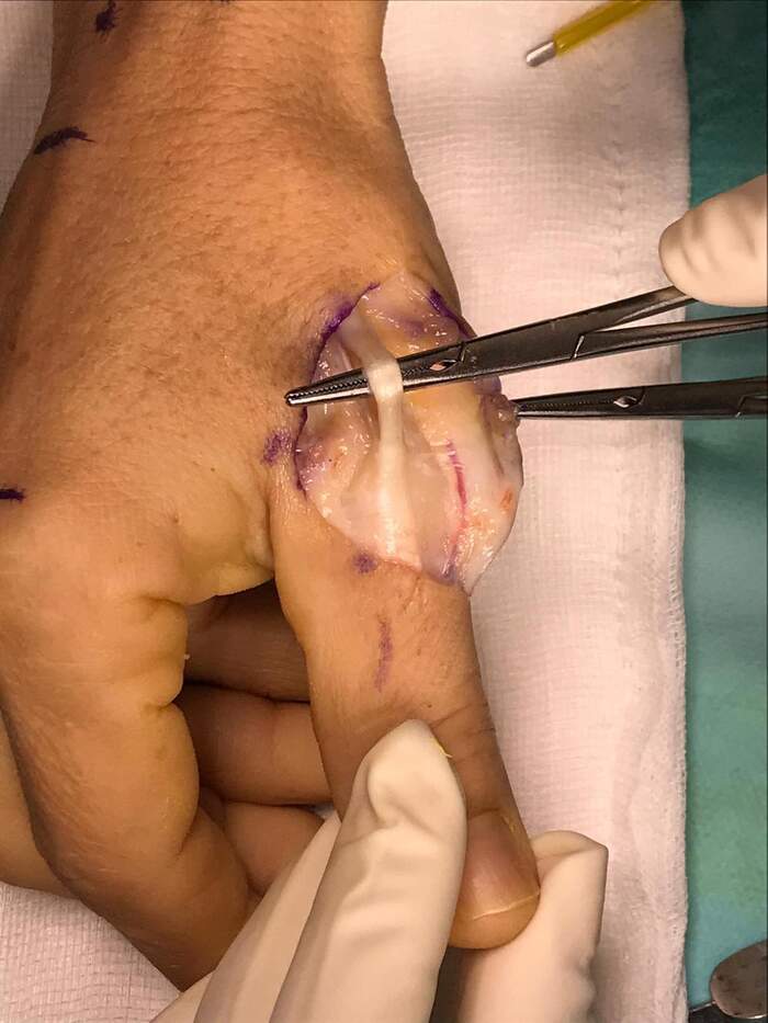 Sección parcial del tendón extensor del pulgar