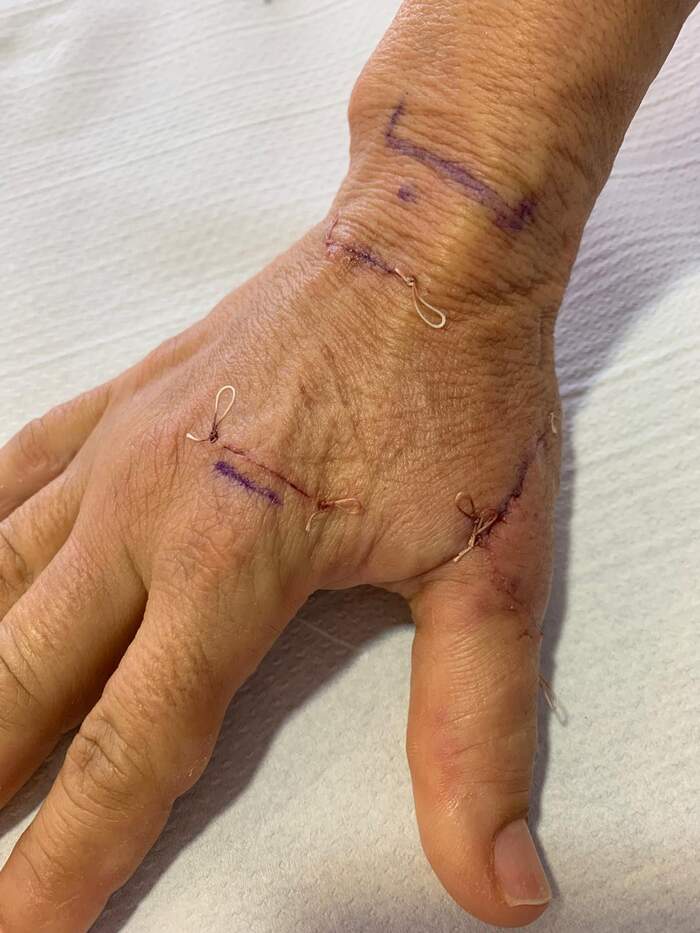Sección parcial del tendón extensor del pulgar