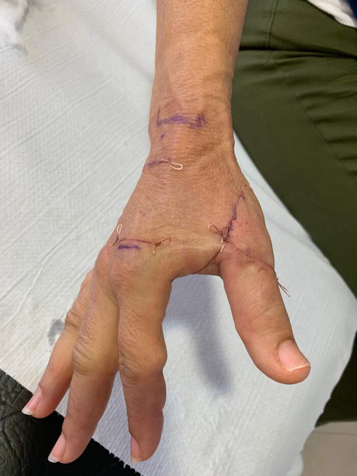 Sección parcial del tendón extensor del pulgar