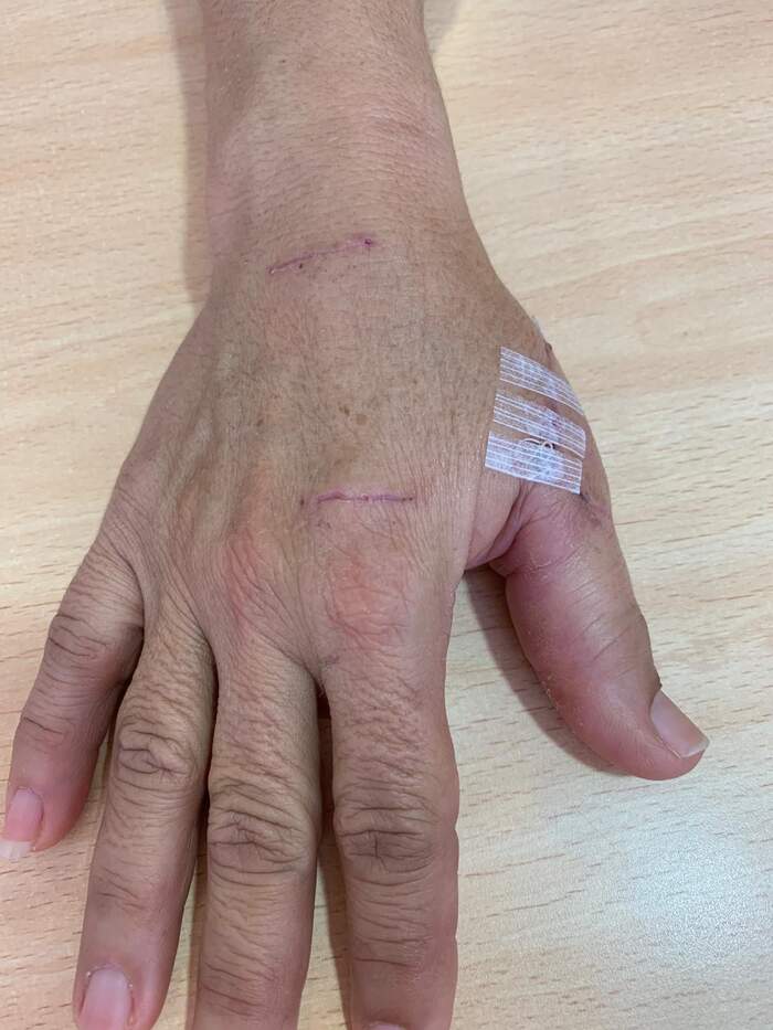 Sección parcial del tendón extensor del pulgar